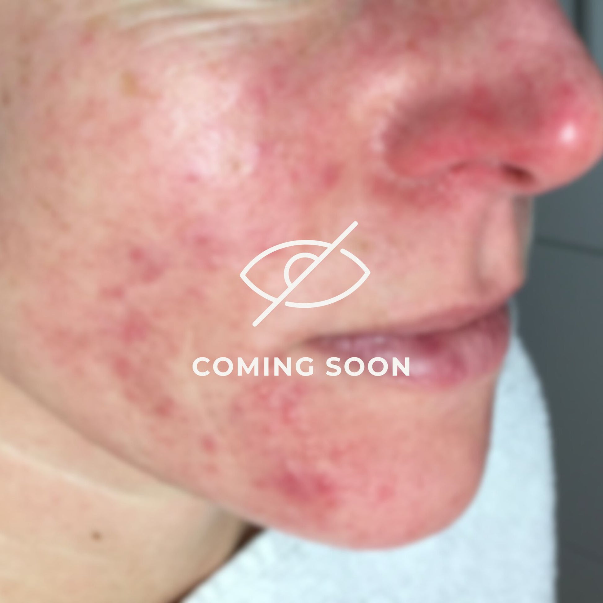 ScKIN Nutriton, Rosacea Program